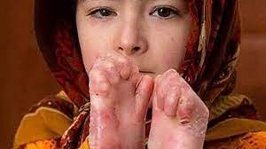 سكاڵای بنه‌ماڵه‌ی تووشبووانی نه‌خۆشی په‌روانه‌یی له‌ بۆنیادی نه‌خۆشییه‌ تایبه‌ته‌كان
